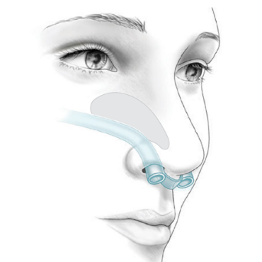 post-op nasal airways